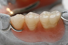 протезы зубов из пластмассы